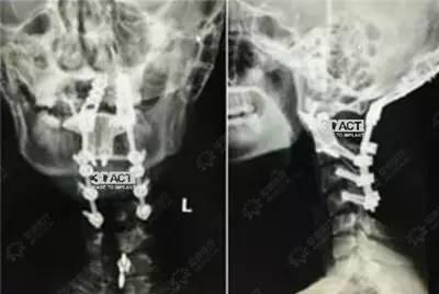 国产爱康髋关节视频,创新科技引领关节置换新篇章